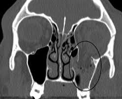 Etiologi trauma tumpul tidak langsung ke orbita. Orbital Blowout Fracture Wikipedia