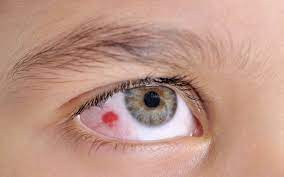 Welche ursachen können rote augenlider haben? Rote Augen Gerotete Augen Ursachen Therapie Onmeda De