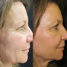 I couldn't be any simpler with my nutrition recommendations for fat burning. Sagging Jawline Give Those Jowls A Lift Paradise Medspa