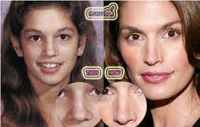 Cindy Crawford Plastic Surgery Plastic Surgery Nose Job Rhinoplasty