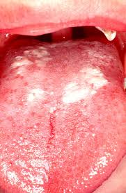 Image result for white cancer on tongue)