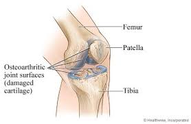 Knee Replacement Surgery University Of Michigan Health System Partial Knee Replacement Knee Replacement Knee Arthritis