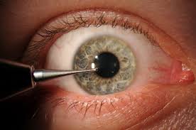 Image result for Eye Foreign Body