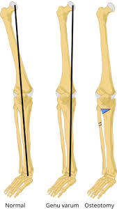 Image result for Genu Varum