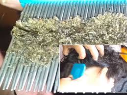 A female head louse produces about four eggs per day and a total of about 88 eggs during her lifetime. Is This The Worst Case Of Head Lice Ever Video Shows Girl Infested With Hundreds Of Nits World News Mirror Online