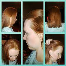 The Baldness To Androgenic That Was Due Male Pattern Baldness Or Alopecia Bedeviled And Offers Discou Male Pattern Baldness Pattern Baldness Hair Care Tips