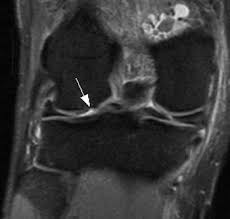 There are two condyles on each leg known as the medial and lateral femoral condyles. Cartilage Defect Of Lateral Femoral Condyle Radsource