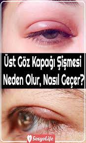 ust goz kapagi sismesi neden olur nasil gecer 2021 gozler dogal saglik saglik