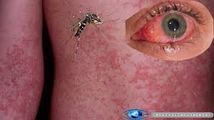 Resultado de imagen para virus zika