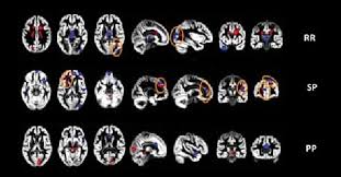 Learn vocabulary, terms and more with flashcards, games and other study tools. Imagenes Presentadas En Convencion Neurologica Derecha Es Derecha Download Scientific Diagram