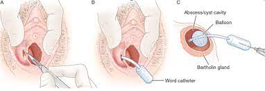 What's The Word? Insertion Of Word Catheter For Bartholin's Cysts |  Department Of Emergency Medicine | Saint John