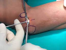 Cureus Cost Saving Minimal Incision Endoscopic Assisted Cubital Tunnel Release Using Simple Surgical Instruments Case Series