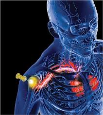 Image result for Intraosseous Access