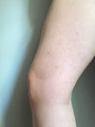 Image result for Keratosis pilaris