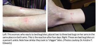 Bed Bug Supplement How Bed Bug Bite Reactions Differ Pct Pest Control Technology