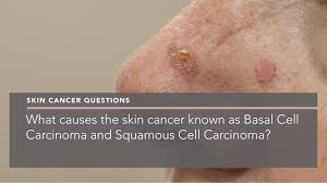 Patients diagnosed with melanoma have an increased risk of developing all other types of skin cancer. What Causes The Skin Cancer Known As Basal Cell Carcinoma And Squamous Cell Carcinoma Penelope Pratsou Reading Dermatologist