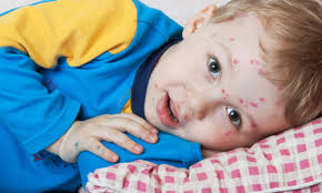 Chickenpox, also known as varicella, is a highly contagious disease caused by the initial infection with varicella zoster virus (vzv). Die 8 Besten Naturlichen Helfer Bei Windpocken