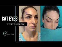 Lower Lid Blepharoplasty demonstrated by Mark Boerner MD