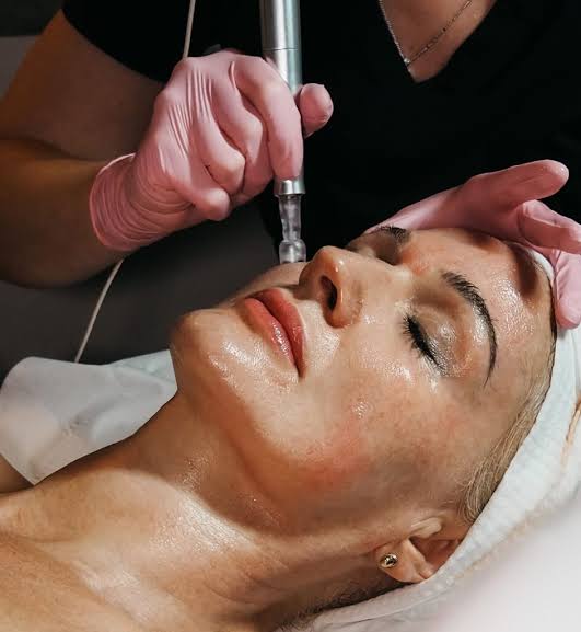 Micro-Needling London - Young LDN