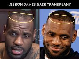 LeBron James Hair Transplant
