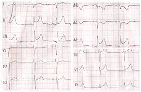 With inflammation of the adjacent pericardium, ecg features of pericarditis can also been. Acute Myocarditis Mimicking St Elevation Myocardial Infarction A Case Report And Review Of The Literature
