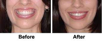 Gummy smiles are perfectly normal and are not a medical condition. Botox For Gummy Smile Dermaskin Clinic