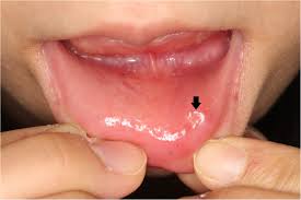 Oral manifestations of syphilis are multiple and highly variable, and often detected in secondary stage. Sonographic Appearance Of Syphilitic Induration Mimicking Squamous Cell Carcinoma In The Lower Lip A Case Report Journal Of Medical Case Reports Full Text
