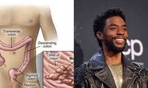 Chadwick boseman's death cause was a cruel disease. Causes Methods And Prevention Of Colon Cancer Which Killed Chadwick Boseman Black Panther