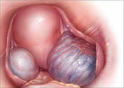 Endometriosis can get worse over time, but in which women this will happen, no one can tell. Strategies And Steps For The Surgical Management Of Endometriosis Mdedge Obgyn