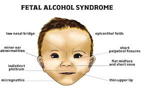 To my knowledge, i have absolutely no asian ancestors, so why are my eyes shaped the way they are? Https Wdh02 Azureedge Net Media Oticon Us Main Download Center Clinical Support Professional All 44547 Clinical Support Fetal Alcohol Syndrome Pdf Rev 3f9f La En