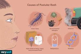 Image result for Pustule