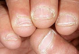 Brown lines that run into the cuticle could be a sign of melanoma. Nail Disorders What Nails Say About Your Health