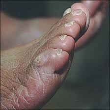 Pictures of corns on feet. Corns And Calluses Resulting From Mechanical Hyperkeratosis American Family Physician