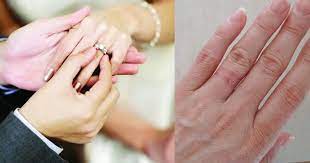 Everything You Must Know About Engagement Or Wedding Ring Allergy Wedding Ring Allergy Wedding Ring Rash Clean Wedding Rings