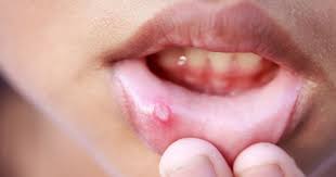 Se presoară cu zahăr sau se pudrează. Cum Se TrateazÄ Aftele La BebeluÈi Èi Copii