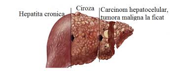 Dislipidemiile reprezintă creşterea colesterolului şi/sau a trigliceridelor în sânge valori normale ale: Regimul Alimentar Indicat Pentru Bolnavii De Hepatita C Buna Ziua Iasi Bzi Ro