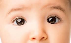 Image result for Strabismus