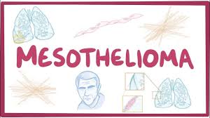 New cases are continually diagnosed, although levels are declining with recognition of the asbestos risk and efforts to remove asbestos from the workplace. Mesothelioma An Osmosis Preview Youtube