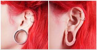 Pixie ears are ears that resemble those of legendary fairies: Extreme Reversal Fixing Gauged Ears Through Plastic Surgery