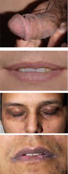 Cutaneous Chronic Graft-Versus-Host Disease: Clinical Manifestations,  Diagnosis, Management, and Supportive Care