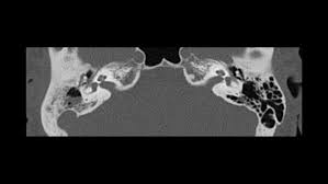 It is predominantly a disease of the developing world. Chronic Suppurative Otitis Media With Acquired Cholesteatoma
