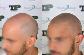 La micropigmentazione applicata ai capelli è una tecnica del tutto innovativa, nata per mascherare inestetismi come la calvizie o per coprire cicatrici . Tricopigmentazione E Ricostruzione Frontale Alliance4hair Com