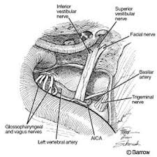Trautmann's triangle (tt) faces the cerebellopontine angle and is exposed during posterior transpetrosal approaches. Surgical Approaches For Resection Of Acoustic Neuromas Barrow Neurological Institute