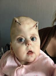 Here's our Sara at just 6 months old, after her first operation at Temple  Street Children's Hospital. Sara was born with a rare genetic condition  called Muenke Syndrome. Since that first surgery… |