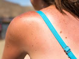 Black tea bags for sunburn. Black Tea Is The Best Way To Treat Sunburn
