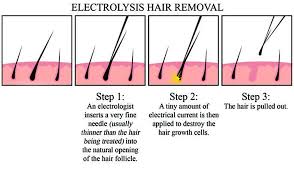 Your identity is safe with me and i am proud to serve you! Aesthetic Doctor Discusses Best Permanent Hair Removal Options In Singapore Ubiqi