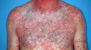 Image result for Generalized Rash