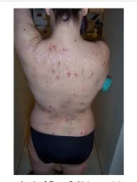 Treating other medical or psychiatric problems morgellons disease complications. Figure 1 From Morgellons Disease A Chemical And Light Microscopic Study Semantic Scholar