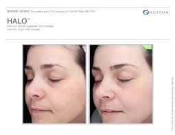 Halo hybrid fractional laser before and after. Sciton Joule Halo Bbl And Microlaser Peel Hybrid Fractional Laser Azura Skin Care Center
