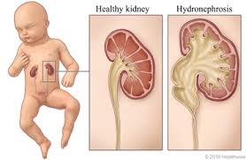 Learning About Fetal Hydronephrosis